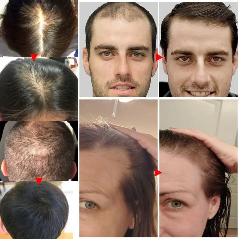 Soro de crescimento rápido do cabelo para homens e mulheres, gengibre natural, anti perda de cabelo, óleo essencial de rebrota, reparo balhead, cabelo danificado, cuidado radicular