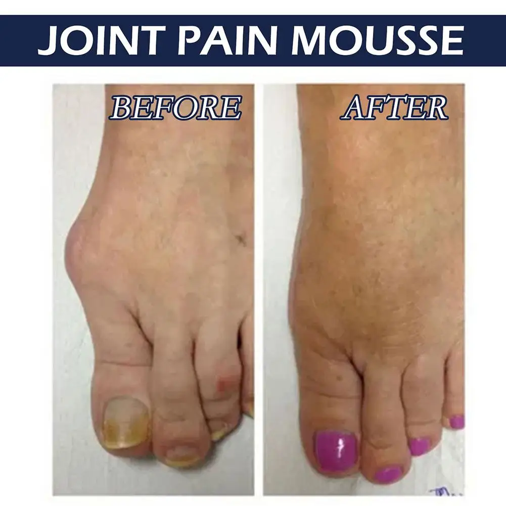 Joint Care Mousse Pain Relief Creme Cervical, Pulso, Joelho, Dor, Dor Lombar, Mão, Músculo Corporal, Dor na Coluna Osso, Artrite, Pé, Perna, Entorse, N I4v8