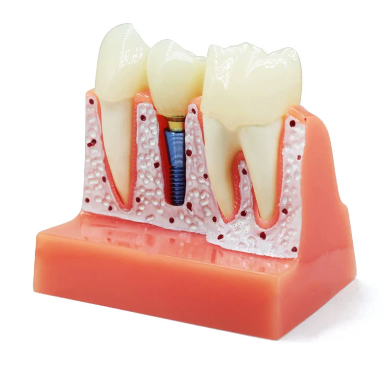 Dental 4 Times Implant Teeth Model Analysis Crown Bridge Removable Model Dental Demonstration Teeth Model Dentisty Study