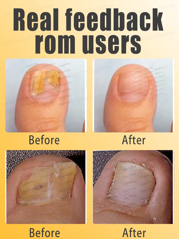 Fungal Nail Repair Fast Onychomycosis Fungus Nails