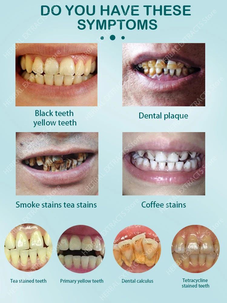 Removal Plaque Stain Teeth Whitening