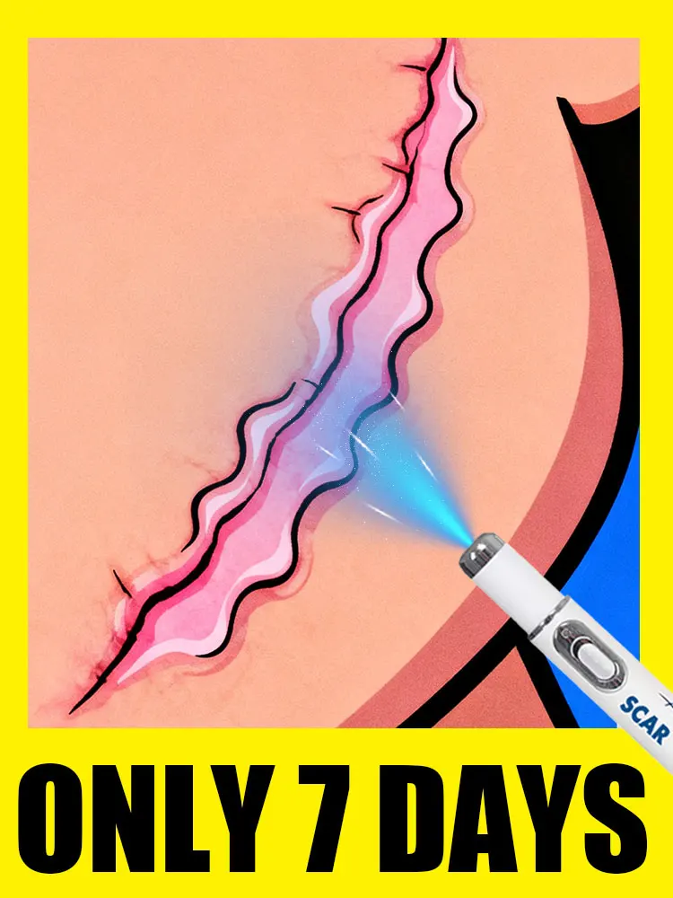 

Supports skin health The second generation of blue laser is used for scars