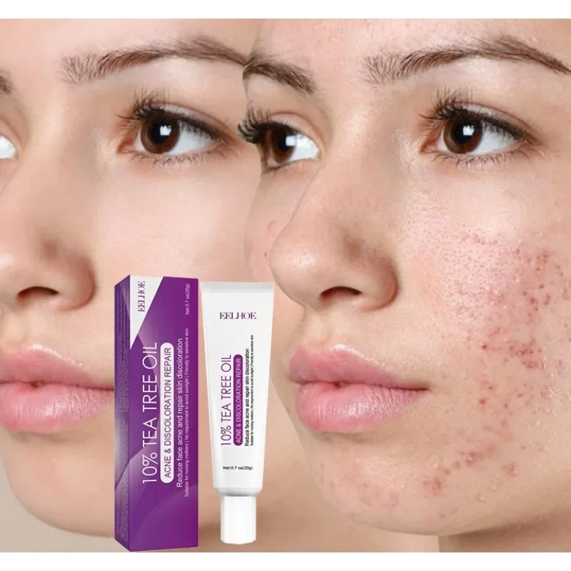 

Acne Treatment Cream Pore Shrink Oil Control Whitening Repair Pimple Deep Cleaning Anti-acne Moisturizer Tea Tree Face Skin Care
