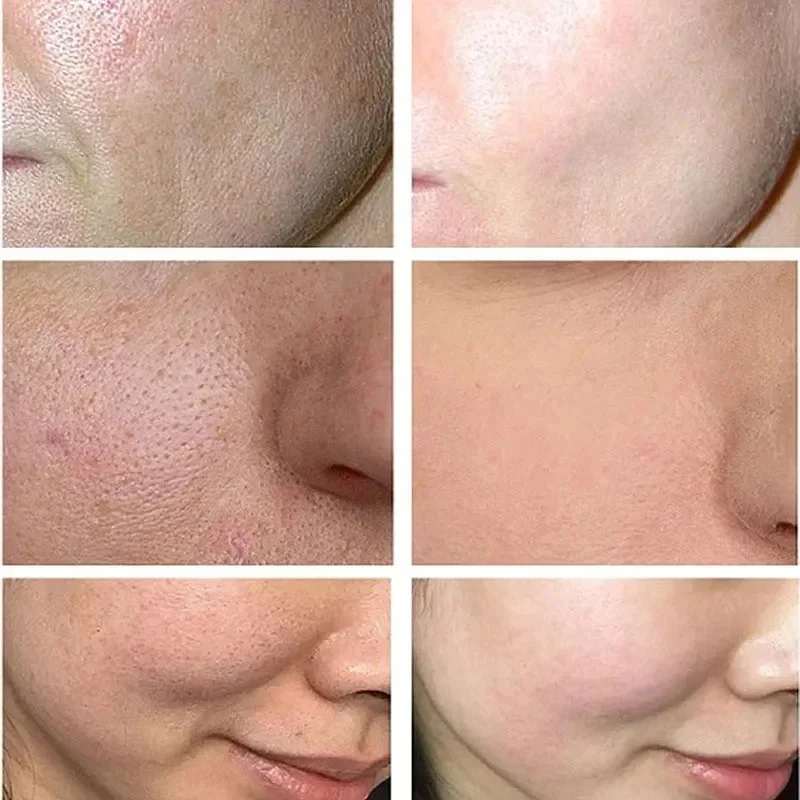 Crème de rétrécissement des pores à l'acide salicVAC, élimination rapide des grands pores, élimine les points noirs, resserre le visage, lisse la peau, produit de soin coréen