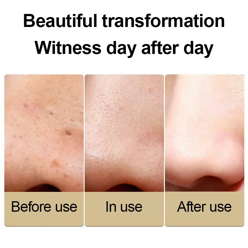 Draagbaar ontwerp Vacuüm mee-eter verwijderaar Gezicht Diepe poriënreiniging Schoonheidstools