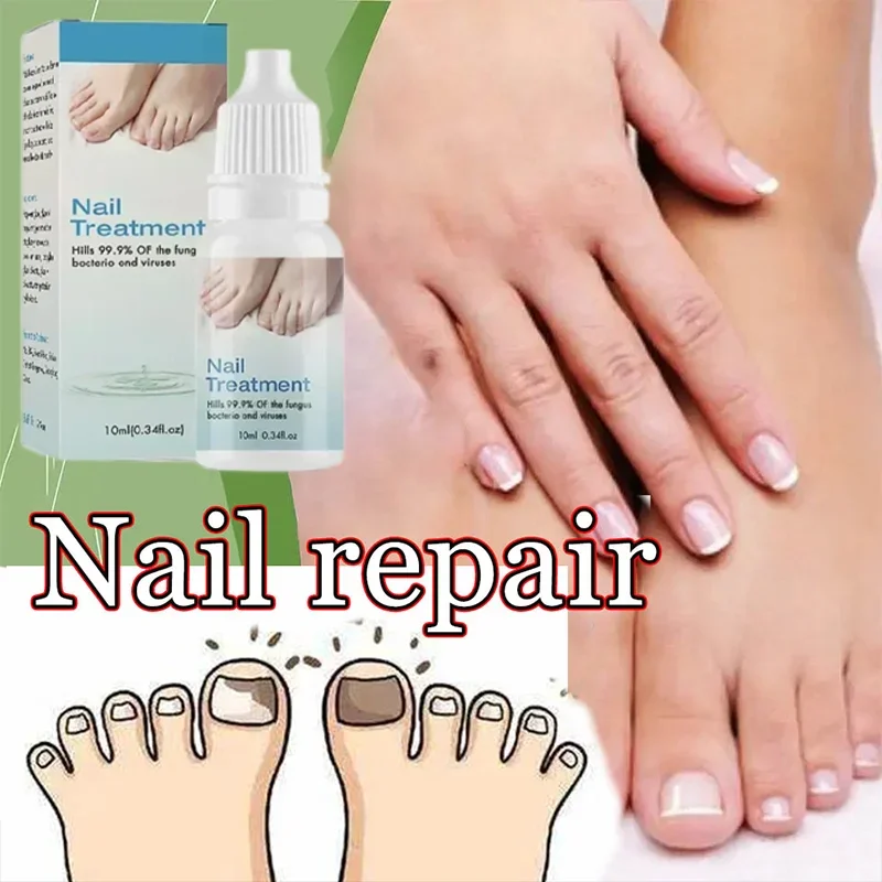 Fungal Nail Treatment Oil Foot Repair Essence Toe Nail Fungus Removal Gel Anti Infection Cream Fungal Nail Removal4363