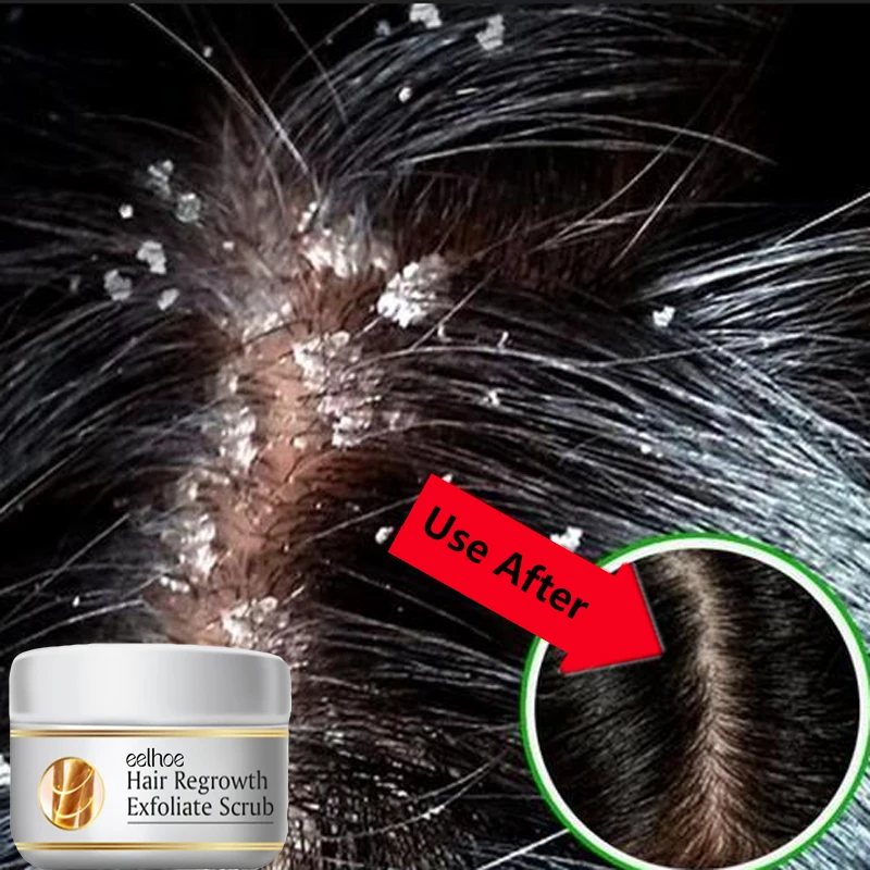 Schnelle Anti-Schuppen-Haare lindern Juckreiz Öl Kontrolle Behandlung Reparatur Kopfhaut Reinigung Peeling-Produkte juckende Haarpflege