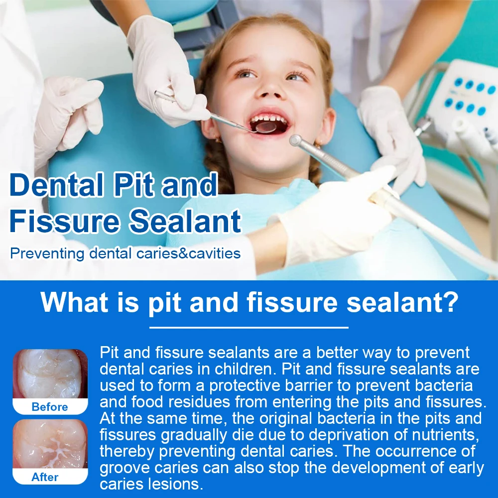 Dental Pit and Fissure Sealant  Light Cure Fluoride-Releasing Resin  Caries Prevention Material for Dentists