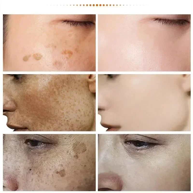 Niacinamide Melasma Brightening Cream Skin Chloasma Serum Fade Fine Lines Reduce Melanin Lighten Dark Skin Cream Face Care