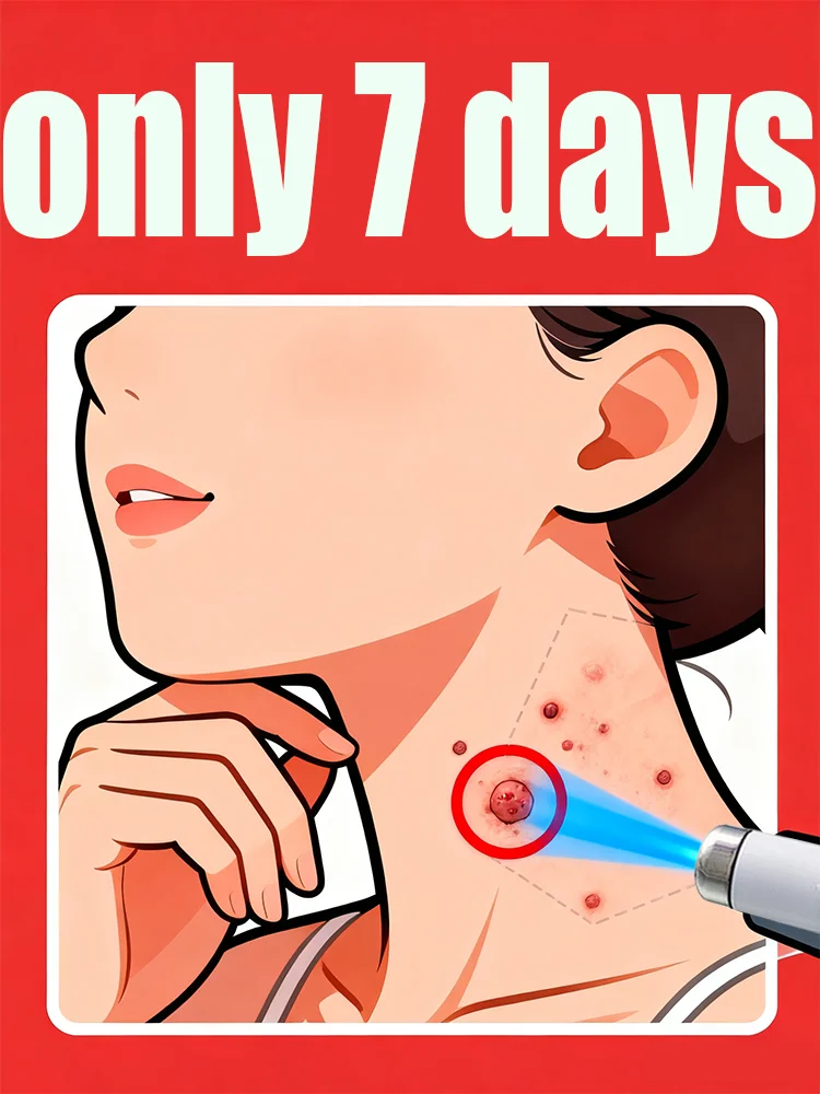 

Generation-2 laser says goodbye to all warts in 7 days