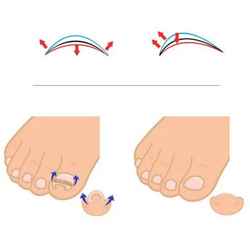 12 Stück / Box Eingewachsener Zehennagel-Korrektor Federdraht-Fixierer Pediküre-Nachrichtungsclip Patch Zehennägel Orthopädische Fußpflege – Detail 7