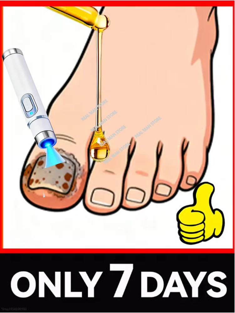 

The fifth generation of champagne-colored nail laser pen helps remove nail fungus, colorless and long-lasting sterilization