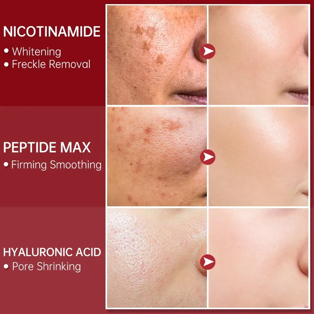 Niacinamida Dark Spot Remover Soro, Hidratante Clareamento Facial, Remoção de ácido hialurônico Soro Facial Sarda, Cuidados com a pele