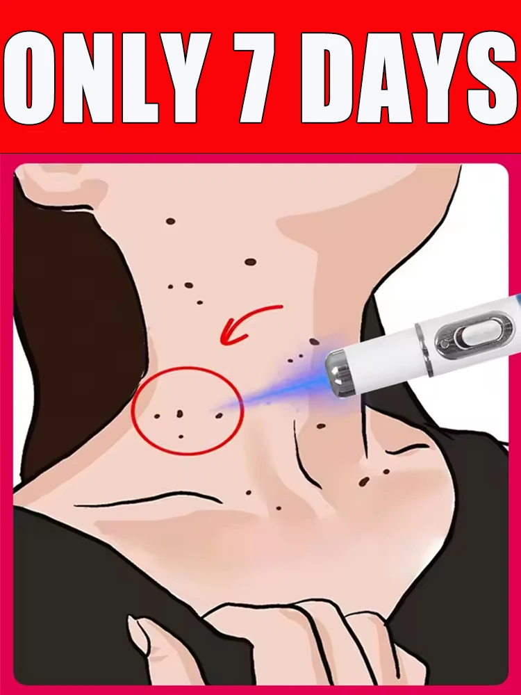 

Blue light wart removal tool, more discounts on sets