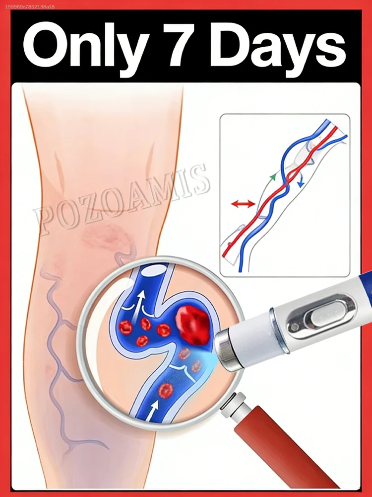 

Don't massage bulging veins on your legs!