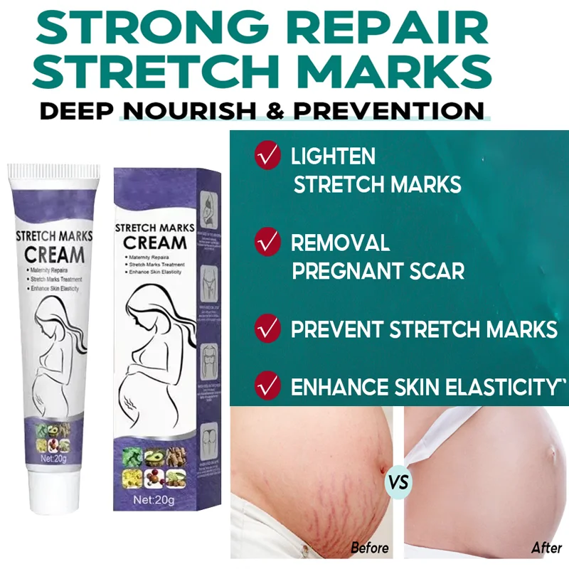 

Крем для удаления растяжек. Эффективный крем для удаления следов. Улучшает эластичность. Укрепляющий лифтинг кожи после беременности. Питает для беременных.