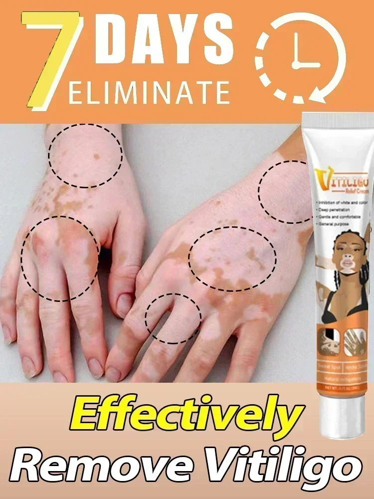 

NewVitiligo Ointment Ringworm Effectively Remove White Spot Removal Skin Vitiligo Eliminate Vitiligo Body Skin Care 1006