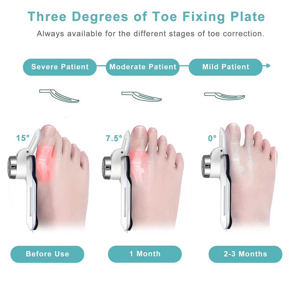 New Bunion Corrector Hallux Valgus Orthotics Big Toe Homing Straightener Adjustable Knobs With 4 Angle Fixing Plate Foot Care