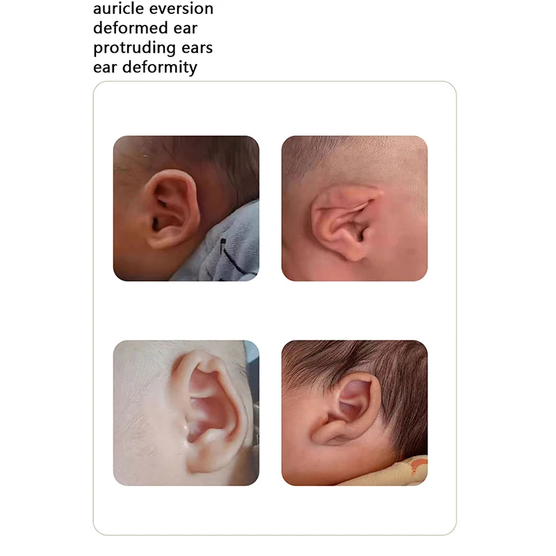 1.5m/Roll Baby Ear Corrector Infant Protruding Ears Correction Silicone Kids Ear Aesthetic Correctors Patch Sticker Ear Care