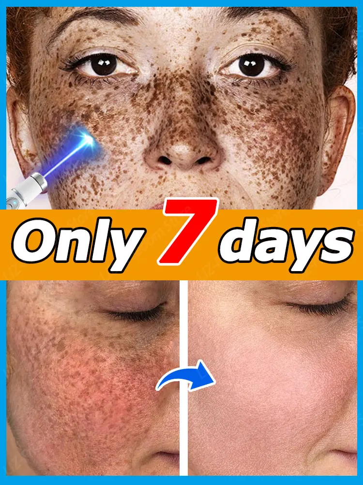 

Highly effective repair facial dark spot freckle