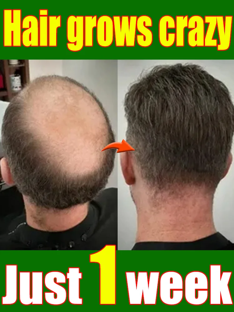 98% покупателей покупают снова, волосы все больше и больше, попрощайтесь с облысением 98% покупателей покупают снова, волосы все больше и больше, попрощайтесь с облысением