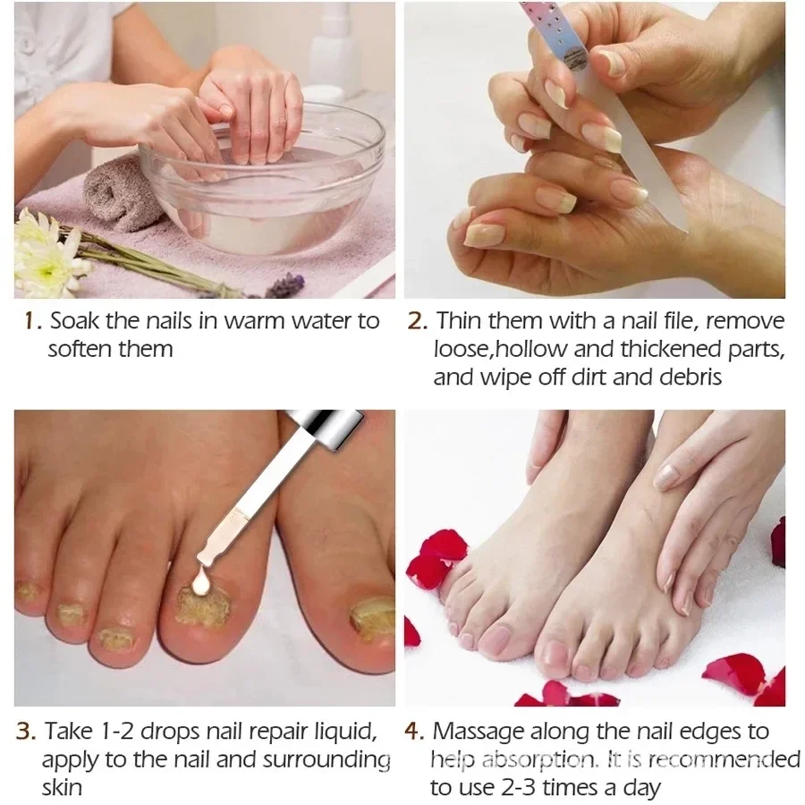 Foot Essence Liquid Treatment Paronychia Hand Feet Removal Repair Anti Infection Foot Care Grey Nail Repair Liquid Fungu