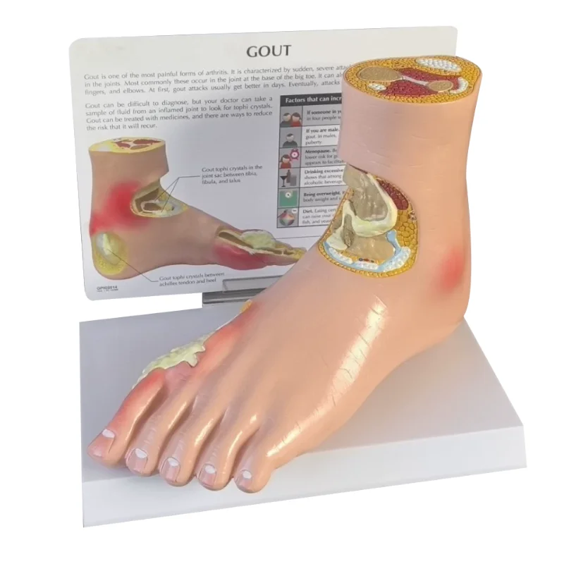 

Diabetes target organ model pain wind stone foot complication model hypertension pathological model foot joint litholysis