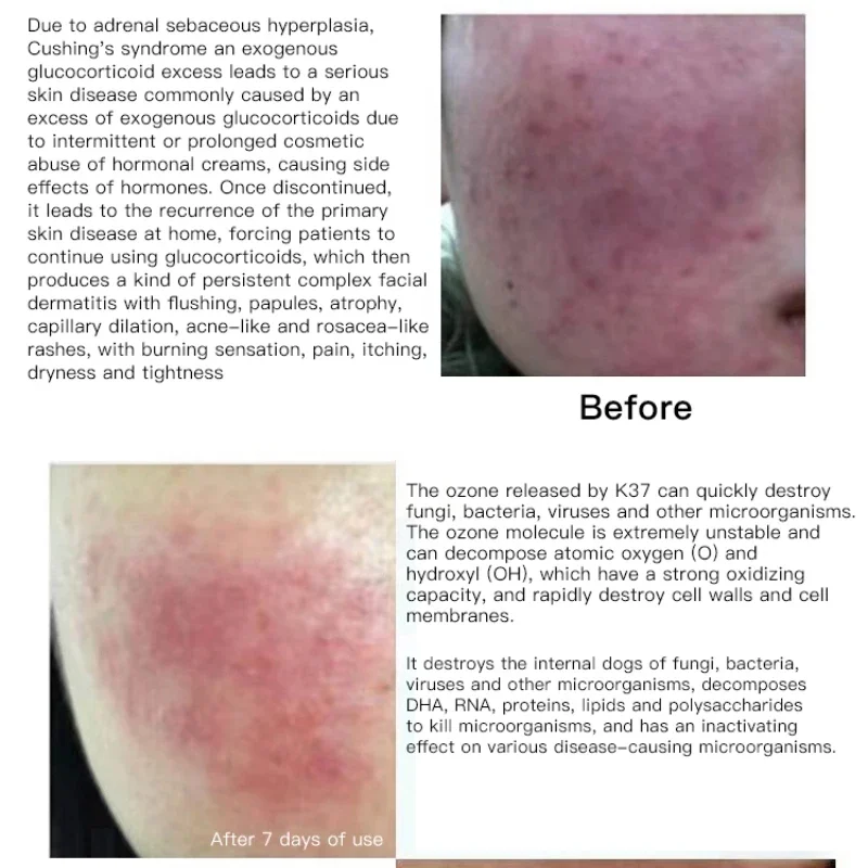 ozone plasma pen acne treatment device beauty instrument Blemish Removal Dead Skin Removal Skin Rejuvenation Skin Mouisture