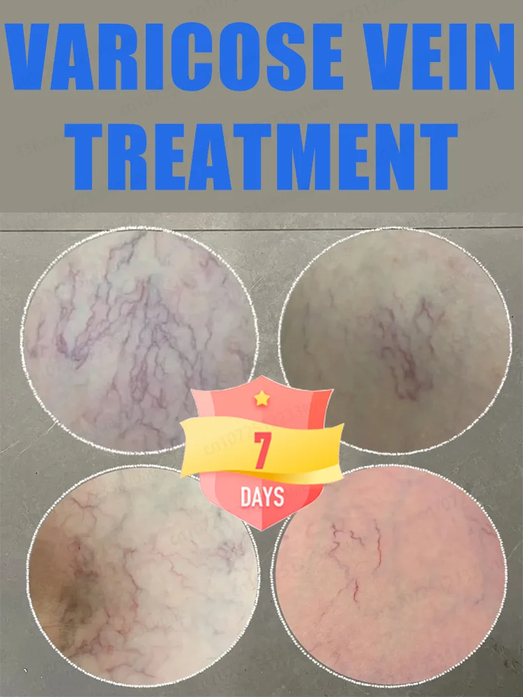 

Generation-2 Laser Says Goodbye To Spider Legs Varicose In 7 Days