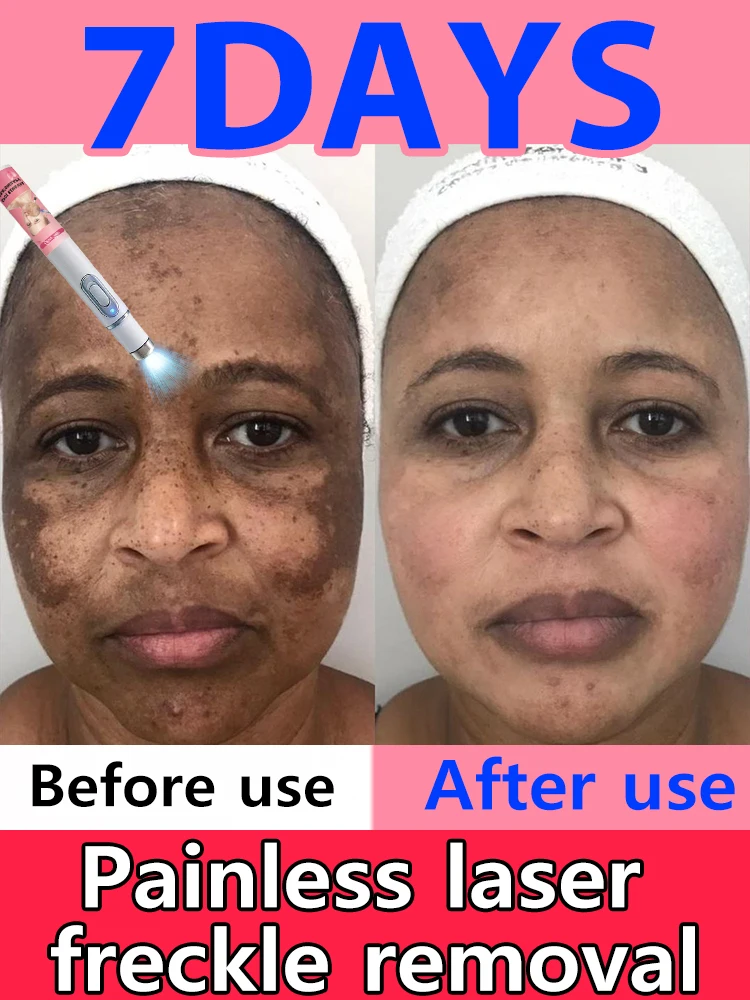 

Engir blettir í andliti, Herrint og Hvítt