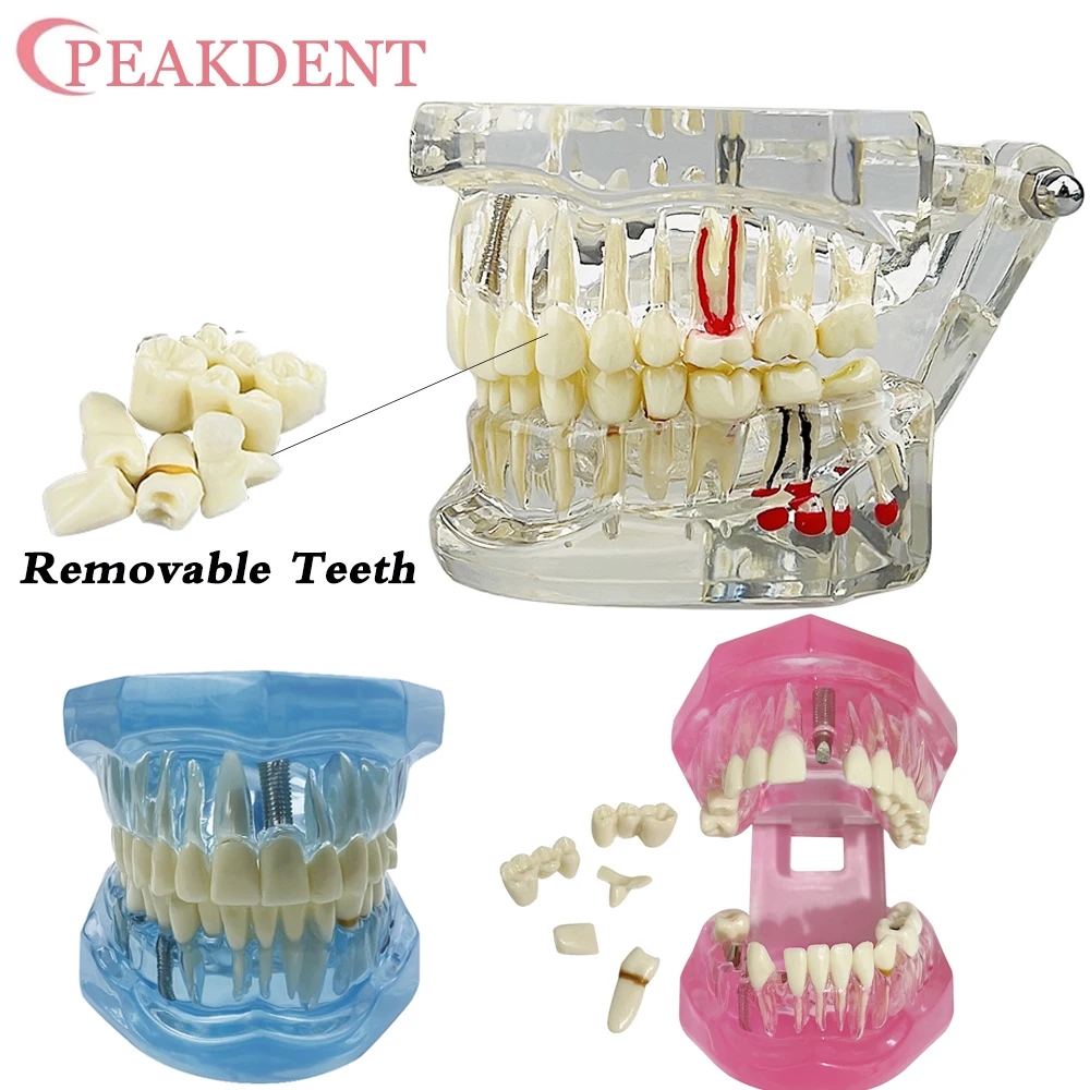 New Dental Model Removable Teeth Model Implant Disease Dentist Studying Teeth Implant Restoration Bridge Teaching Demonstration