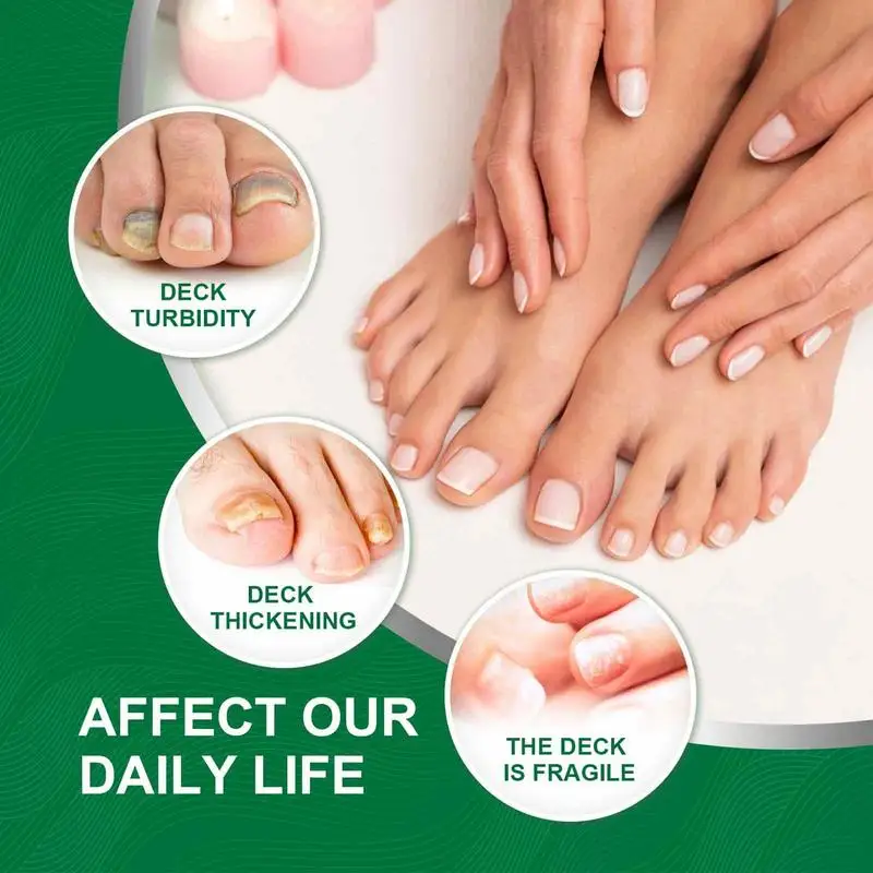 Essência do reparo do prego para o cuidado do toenail, solução para reparar o molde danificado, quebrado rachado, soro descolorido das unhas, essência natural, correção