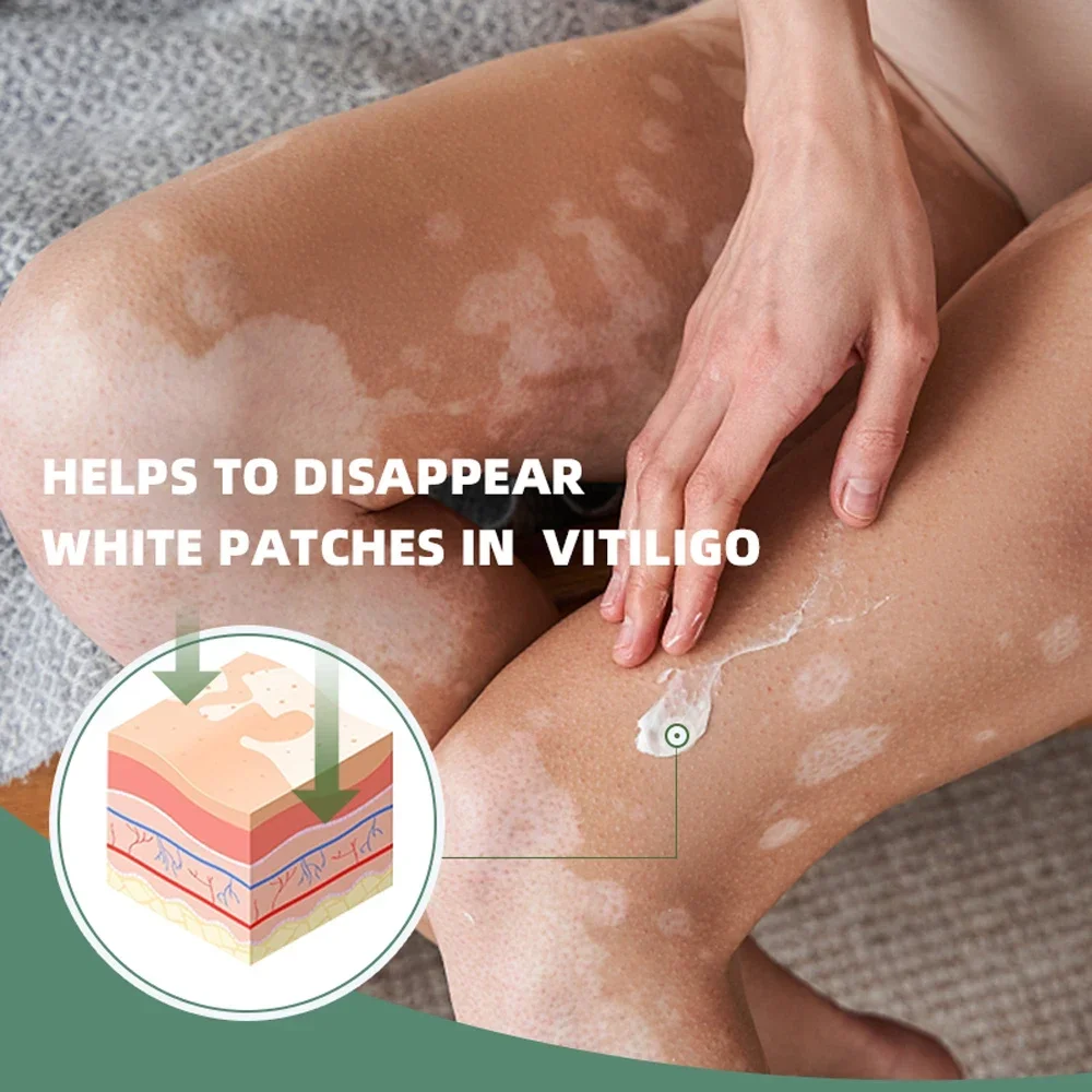 Vitiligo Repair Get Rid Of Ringworm White Spots Get Rid Of Skin Vitiligo Eliminate Vitiligo Better Body Skin