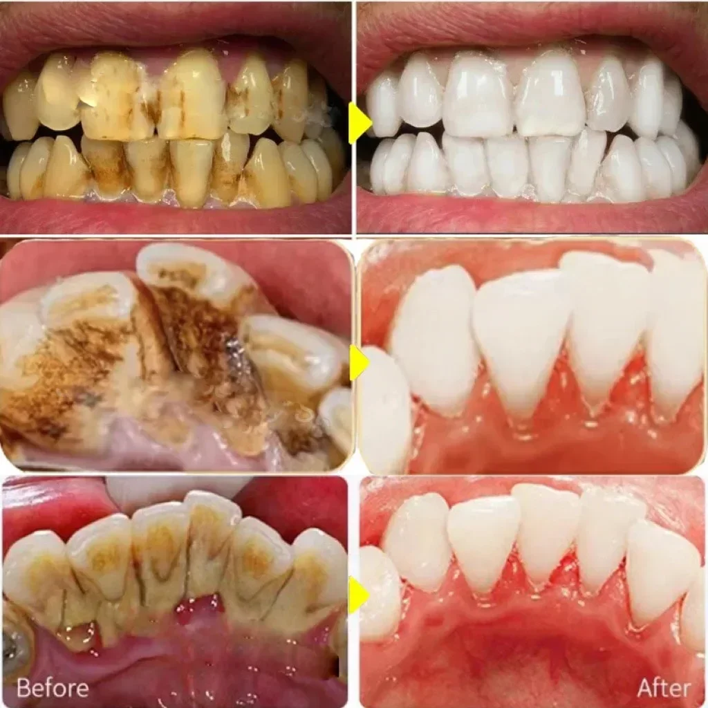 مزيل حساب التفاضل والتكامل الأسنان تبييض الأسنان رذاذ معجون الأسنان تنظيف نظافة الفم إزالة الكريهة البلاك البقع العناية بالنفس الطازج