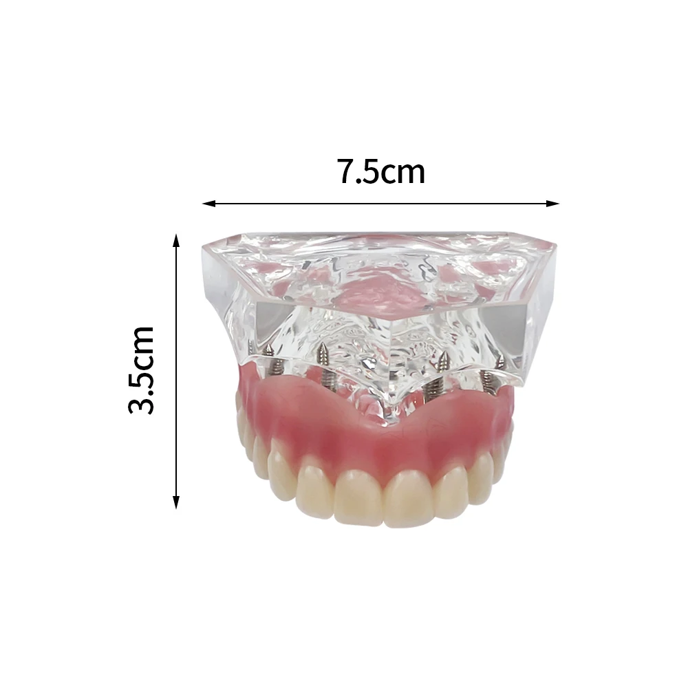 Dental Implant Model Teeth Typodont Model 6001 Upper Jaw Overdenture Removable Bridge 4 Implants Restoration Demonstration Model