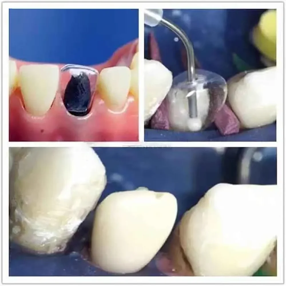 Dental Transparent Temporary Crowns Preformed Posterior Matrices for Adults and Children Professional Dentist Kit