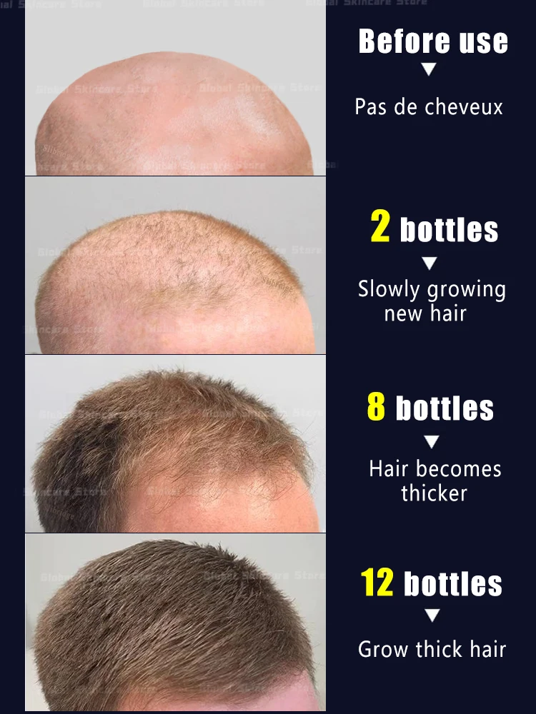 Peigne médical de traitement du cuir chevelu, huile essentielle, masseur de tête, applicateur de cuir chevelu, guide liquide, croissance des cheveux