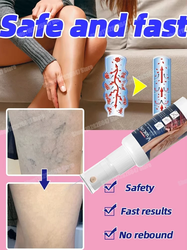 

Varicose Vein Spray Natural Herb Veins Soothing Essential Oil Spray Vasculitis Phlebitis Spider Vein Earthworm Leg Cure