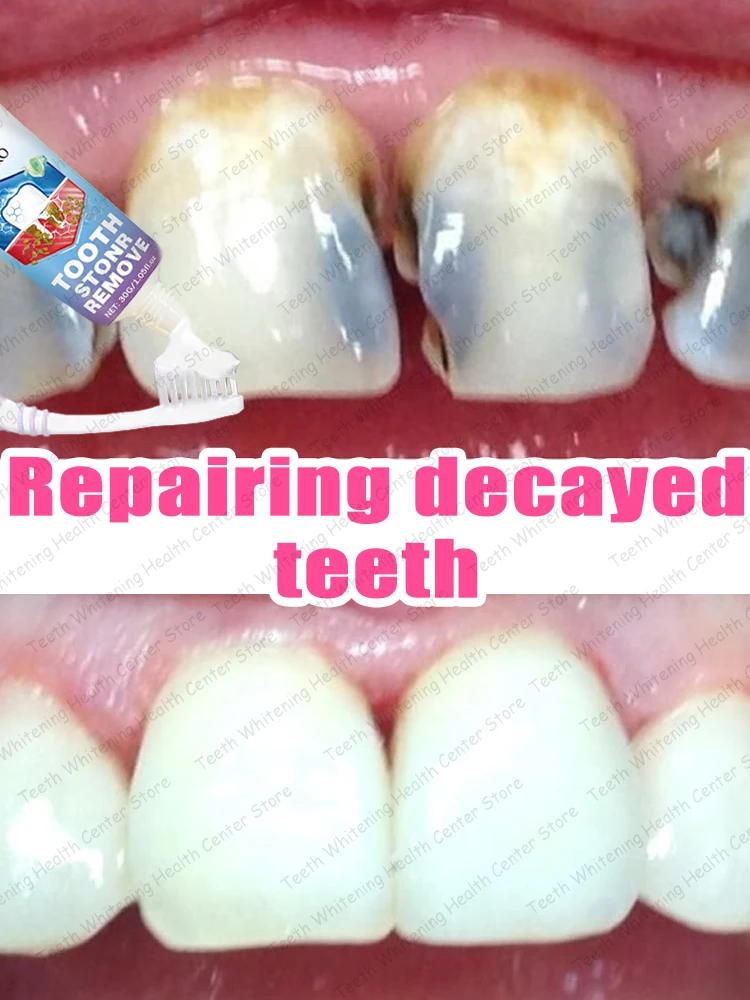 

Cleaning decayed teeth and restoring the oral cavity.
