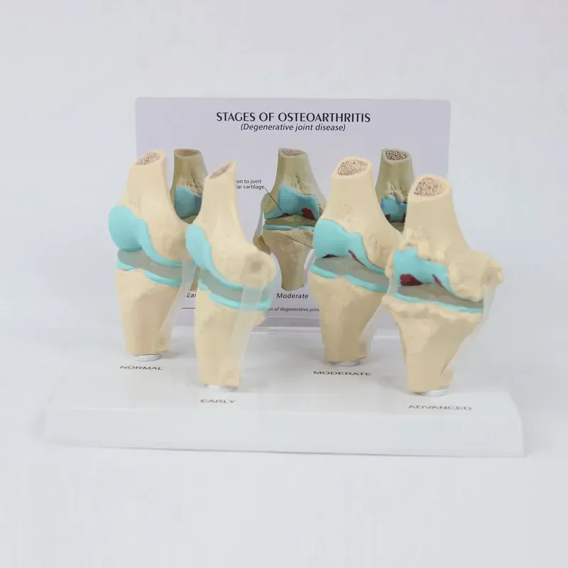 Human Body 4 Stage Knee Joint Model for Anatomy Teaching Aid Bone Joint Display Evolution Demonstration Medical Science