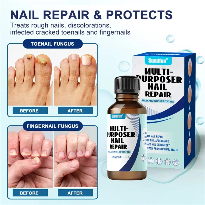 Suero para tratamiento de uñas por hongos, Gel reparador para eliminación de hongos en las uñas de los pies, antiinfección, paroniquia, onicomicosis, esencia para el cuidado de las uñas de los pies