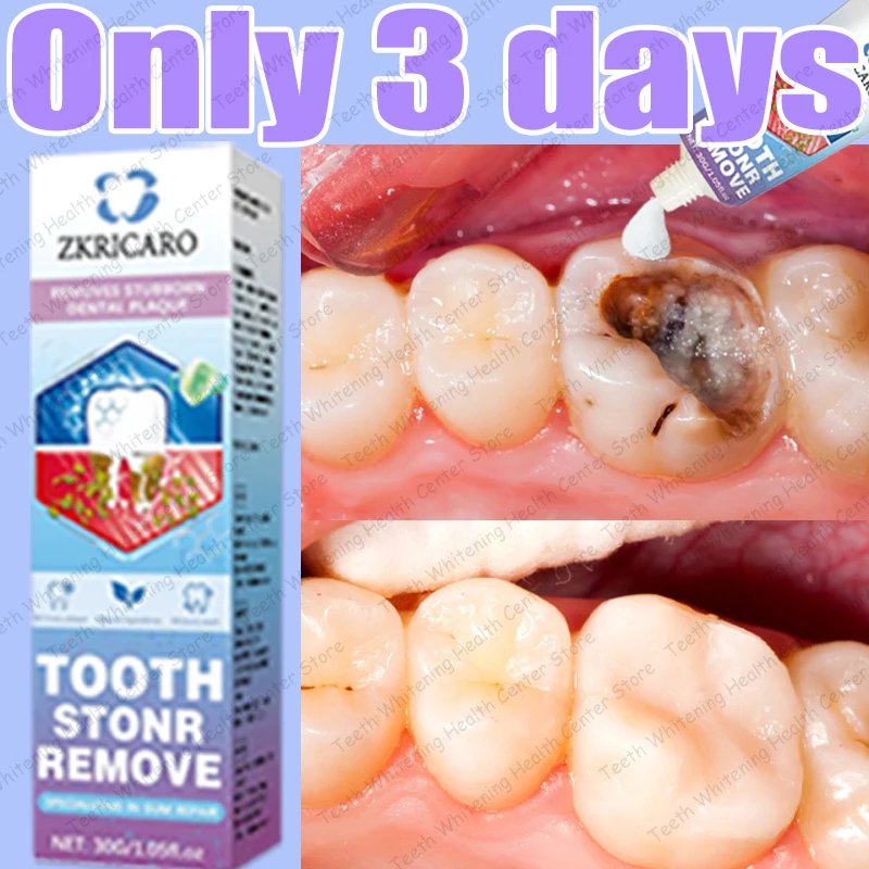 

Hot sale, 99% of people repurchase to repair tooth decay