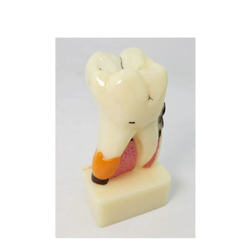 4-voudig Cariësdemonstratie Model Tandmodel