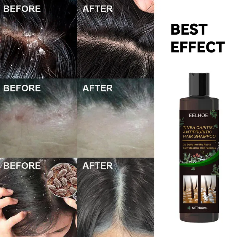 100ml Therapeutic Shampoo Anti-Dandruff Treatment Itching and Flaking Scalp Psoriasis and Seborrheic Dermatitis Shampoo