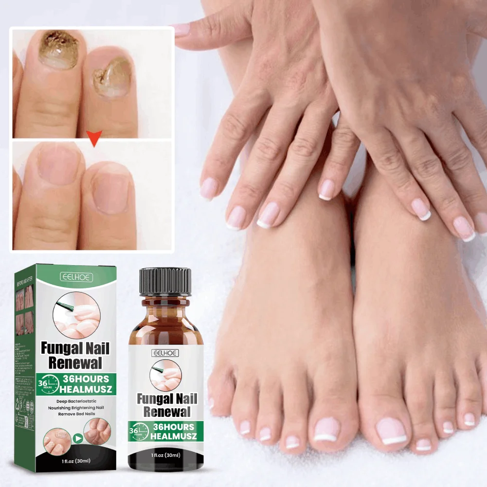 Fungal Nail Renewal Liquid Deep Nail Restoration Serum Improve Discolored Thick Brittle Nails Nourishing Hand Toenail Care Liqui