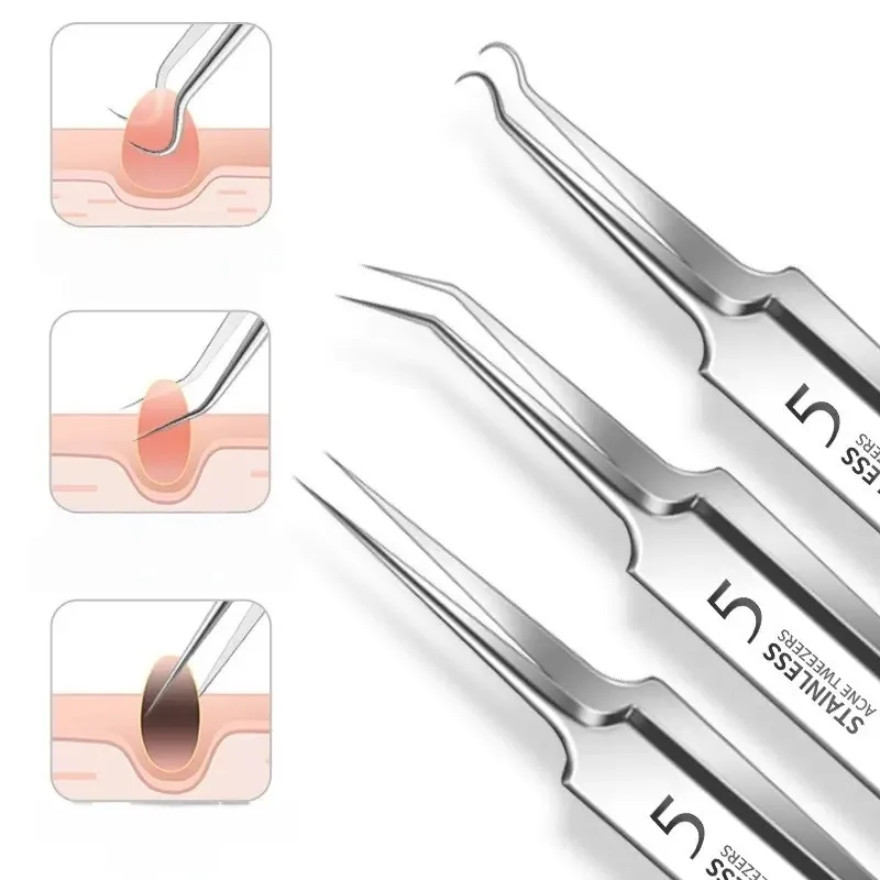 3/8 kit removedor de cravo de aço inoxidável mancha acne ferramentas de extração profissional espinha popper conjunto cuidados faciais ferramentas beleza
