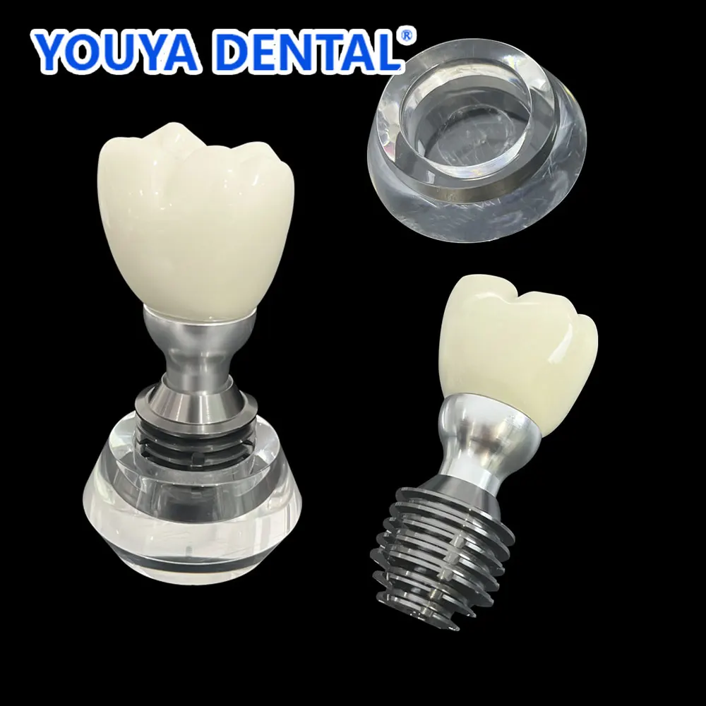 Removable Dental Implant Teeth Model Detachable Crystal Crown Model Transparent for Patient Communication Dentistry Teaching