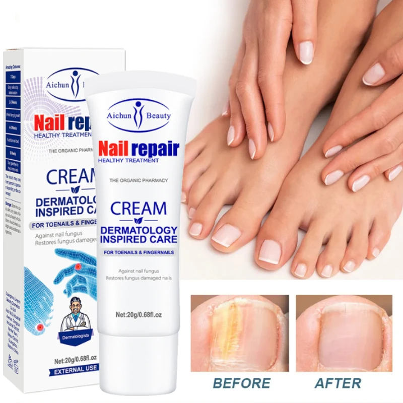 Crème de Traitement Efficace Contre les Champignons des Ongles, Sérum Anti-betection, Paronyamitié, Onychomycose, Gel de Soins