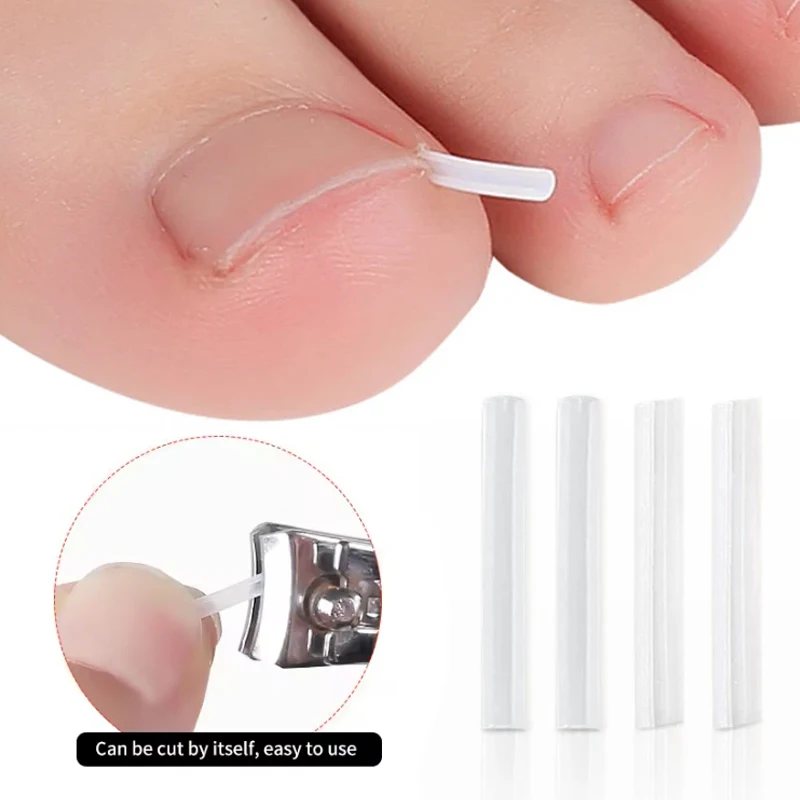 Narzędzie do korekcji wrastających paznokci, wkładka do wypełniania paznokci, leczenie wrastających paznokci, elastyczna plastra, klips prostujący, orteza, narzędzie do pedicure