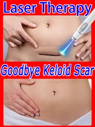 Laser therapie Keloid narbe